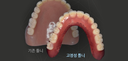 임플란트 틀니