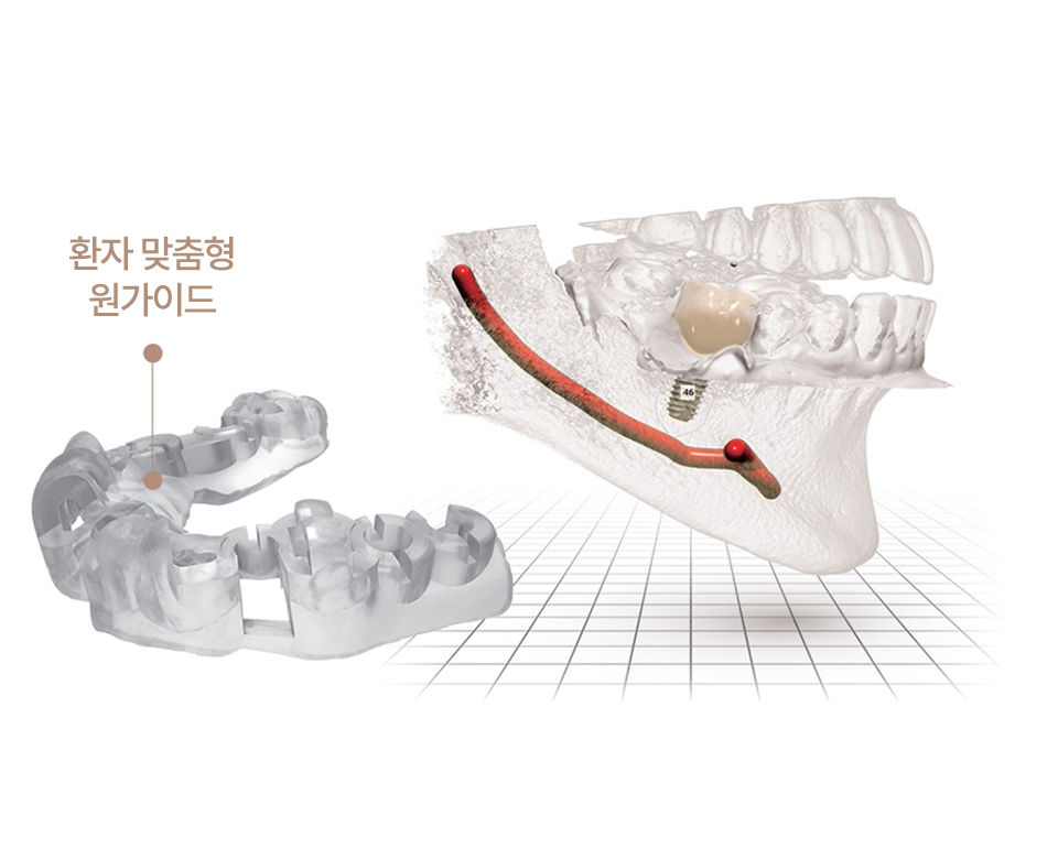 내비게이션 임플란트