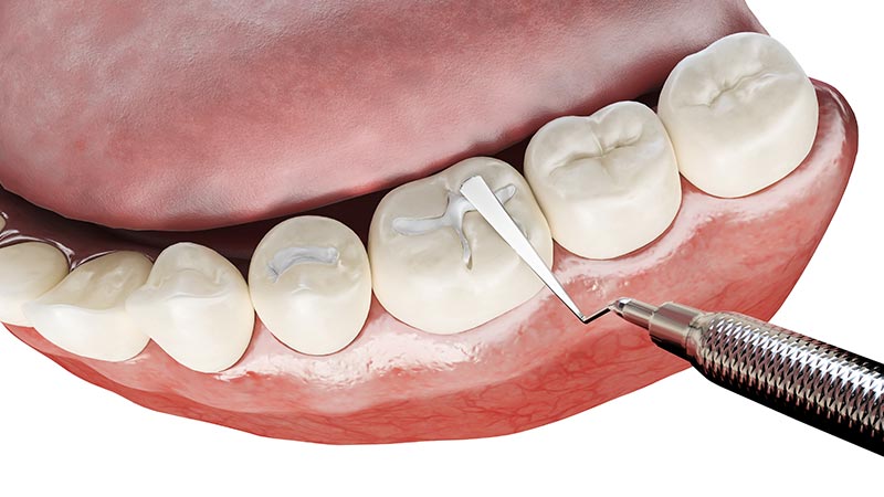 레진