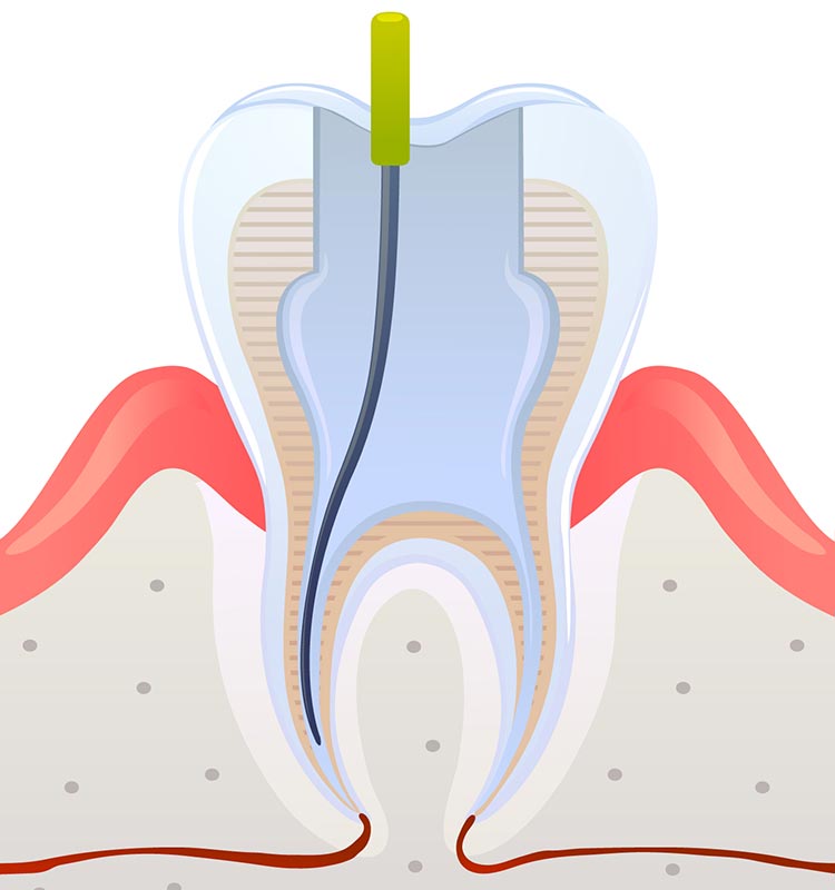 치수제거 및 소독