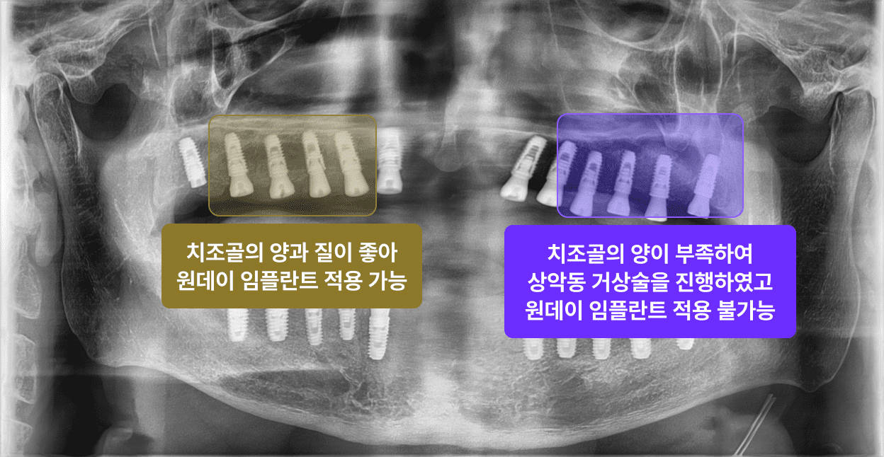 치조골의 상태