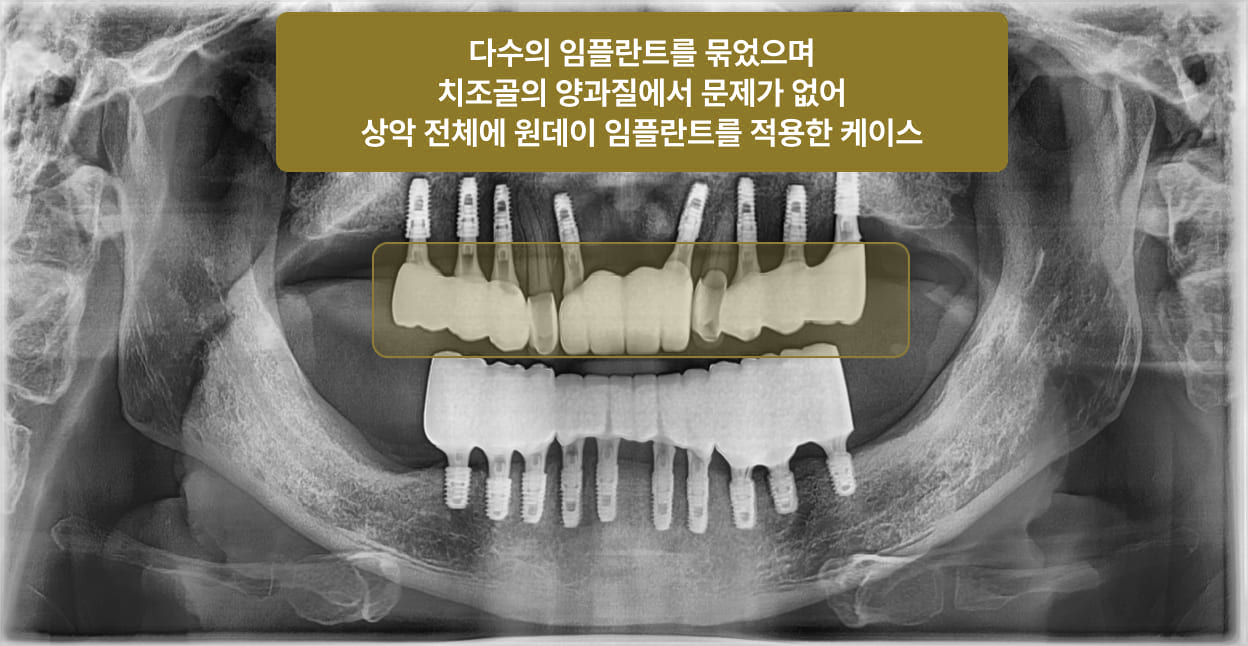 임플란트 2개 이상을 묶어서 원데이 임플란트
